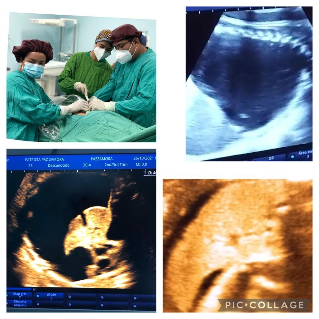 Realizan cirugía fetal en el hospital Bertha Calderón