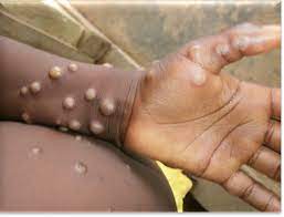 Autoridades de salud en México confirman el segundo caso de Viruela del Mono