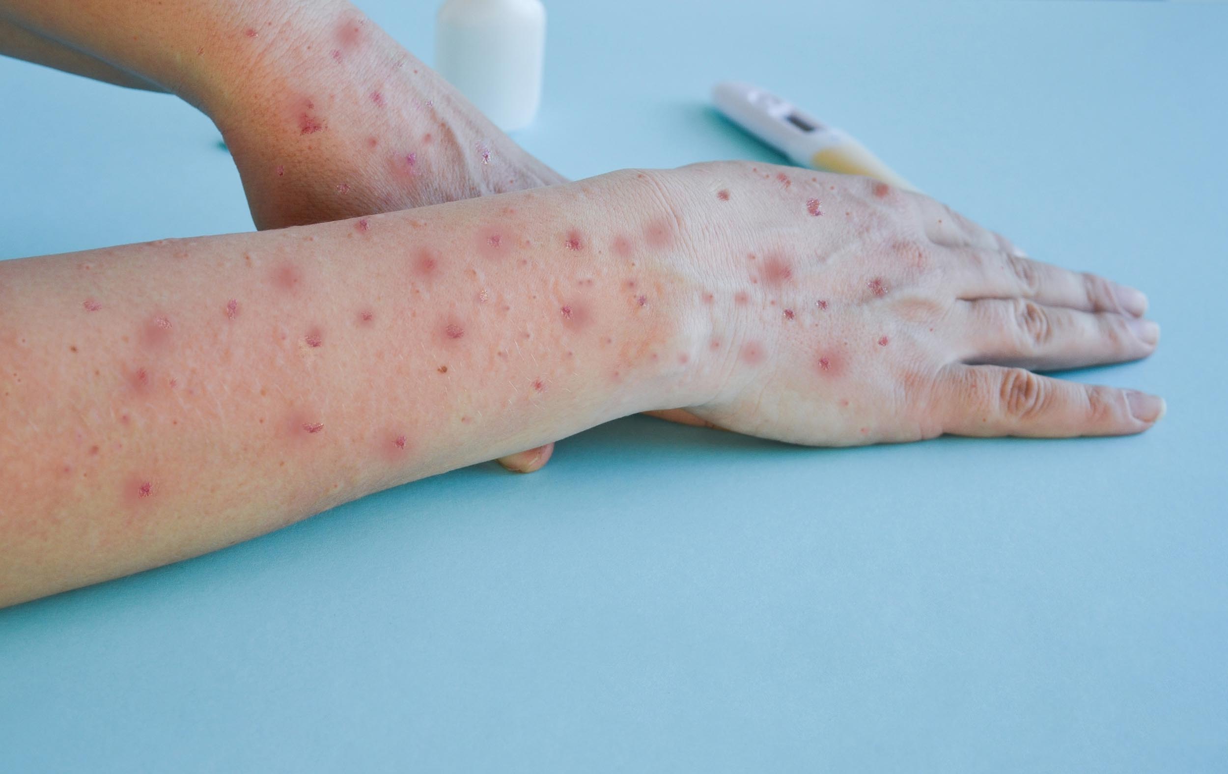 Detectan un brote de 12 casos de viruela del mono relacionado con un centro de tatuajes en el sur de España
