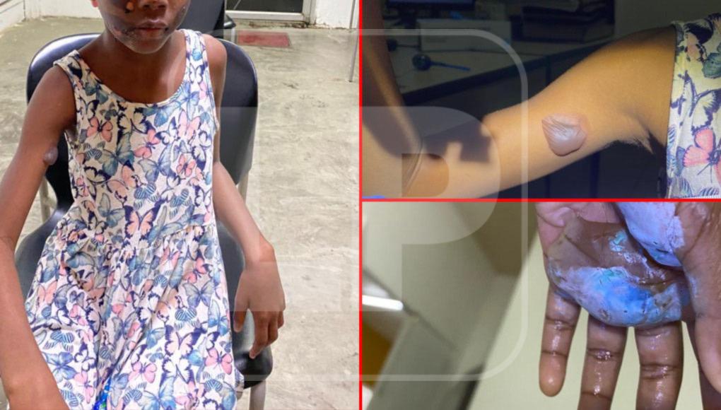 Menor es quemada por su progenitora en Honduras