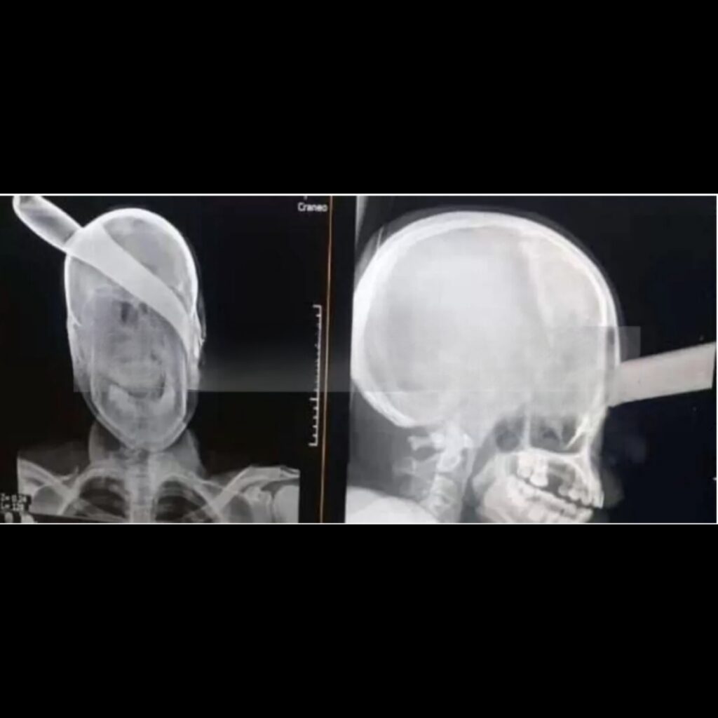 Hombre sobrevive luego que amigo le clavó cuchillo en la cabeza en Managua