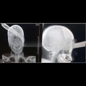 Hombre sobrevive luego que amigo le clavó cuchillo en la cabeza en Managua