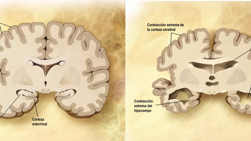 ¿Duermes poco? Científicos explican cómo la falta de sueño incrementa la probabilidad de alzhéimer