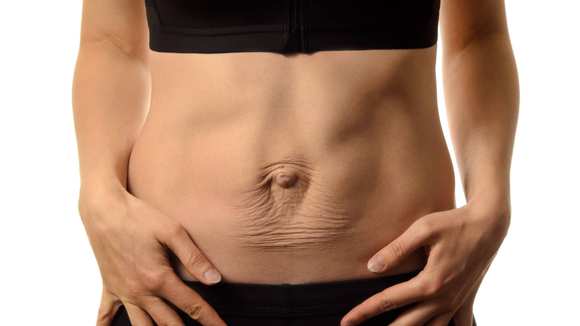 Diástasis abdominal: qué es y cómo tratarla