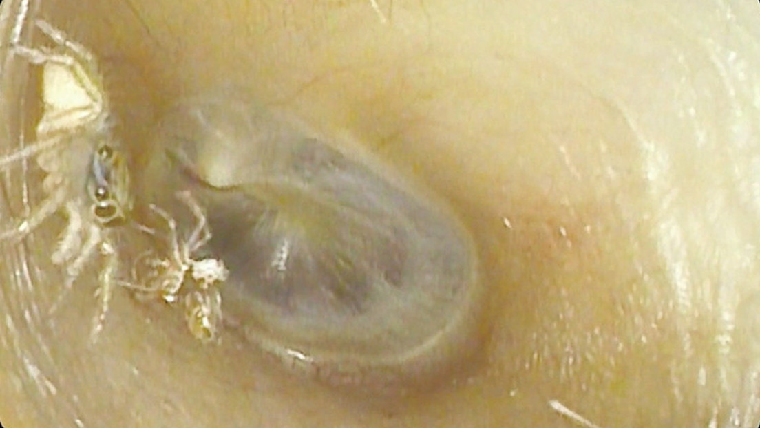 Un médico descubre la ‘aterradora’ razón por la que una mujer oía ruidos en su oreja