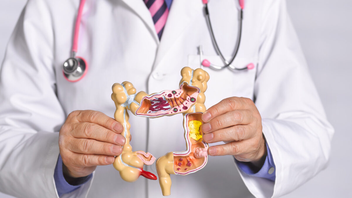 El cáncer colorrectal aumenta en adultos jóvenes a tasas alarmantes, advierte un nuevo estudio en EE.UU.