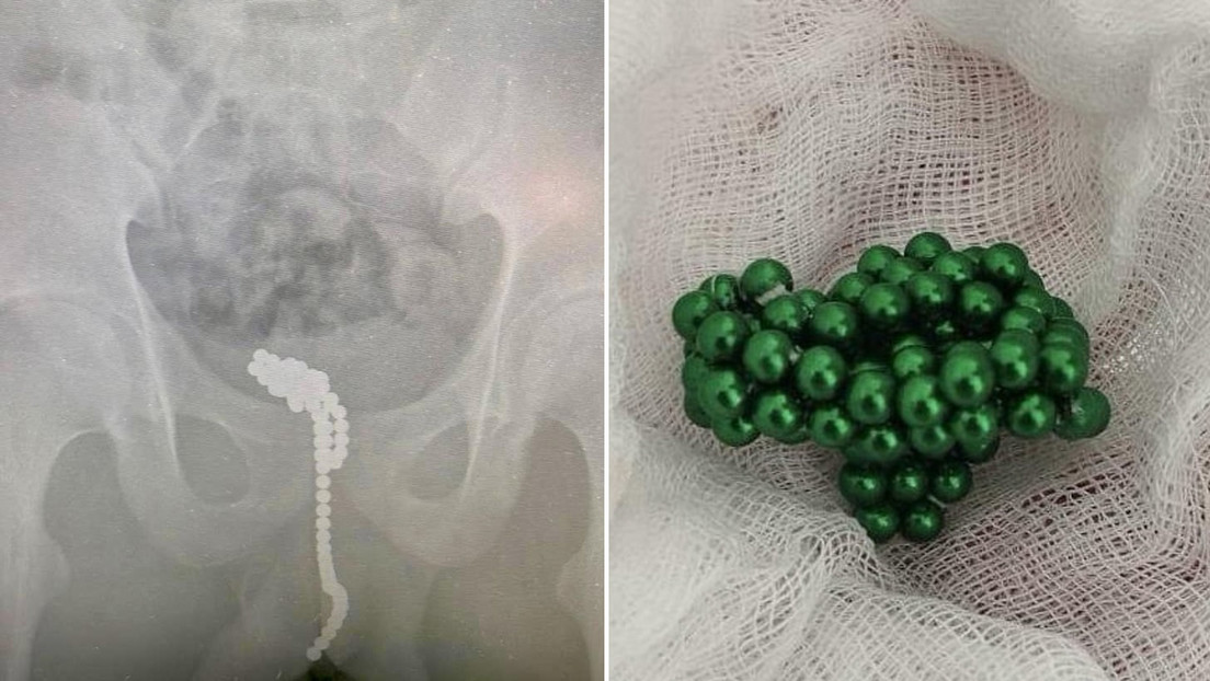 Un adolescente introduce en su pene 50 bolas magnéticas
