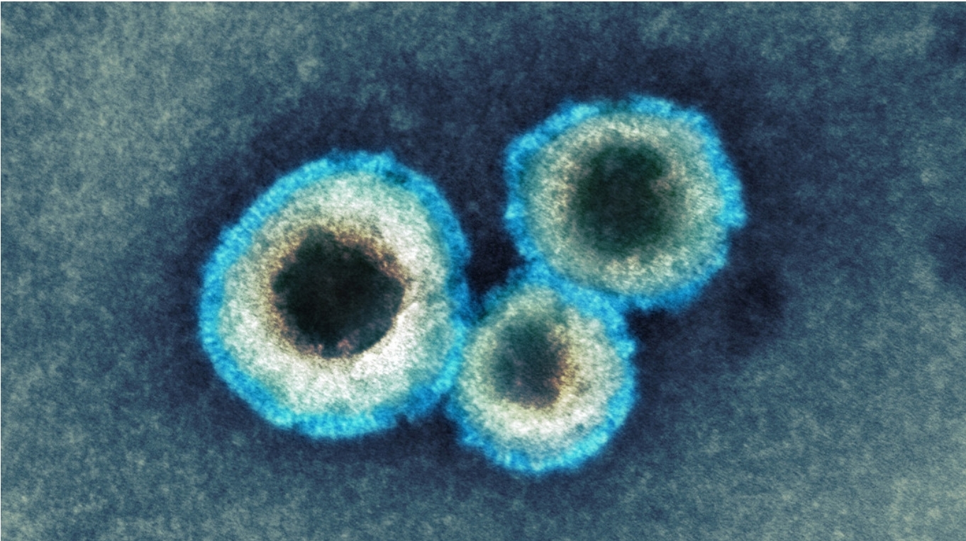 La India confirma primeros casos de metapneumovirus humano