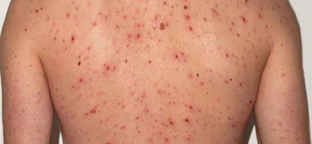 Guatemala vigilancia Sarampión