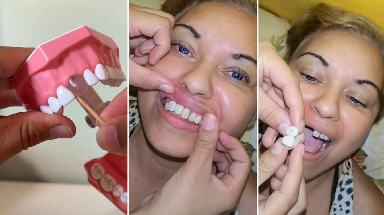 Dientes por TikTok: la peligrosa ‘moda’ que pone en alerta a Brasil