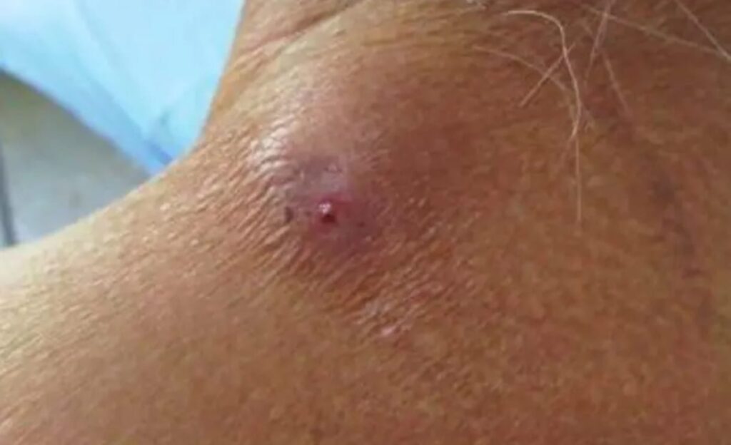 casos de miasis por gusano barrenador