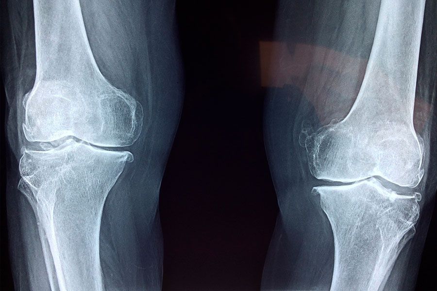 Rotura de ligamentos