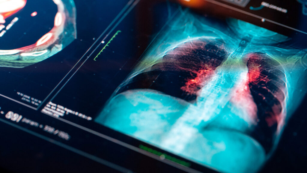 Estas 2 dolencias pueden activar células cancerosas 'dormidas' en los pulmones