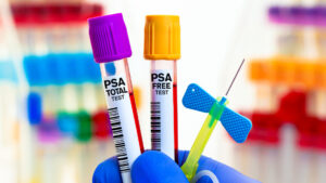 Un tratamiento frío puede ayudar con un tipo de cáncer que a menudo no presenta señales de advertencia