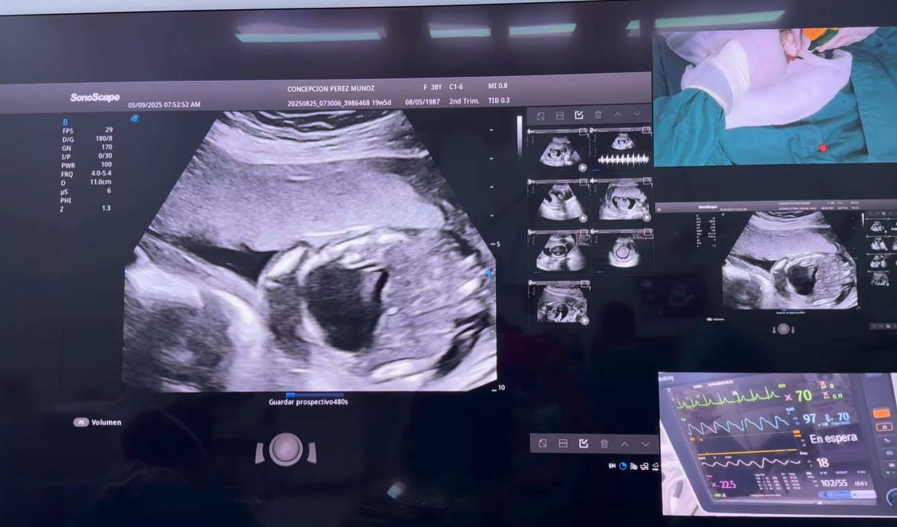 Realizan con éxito la cirugía fetal 284 en el Hospital Bertha Calderón