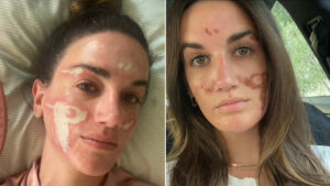 Denuncia a esteticista de famosos por haberle "desfigurado" el rostro de manera permanente