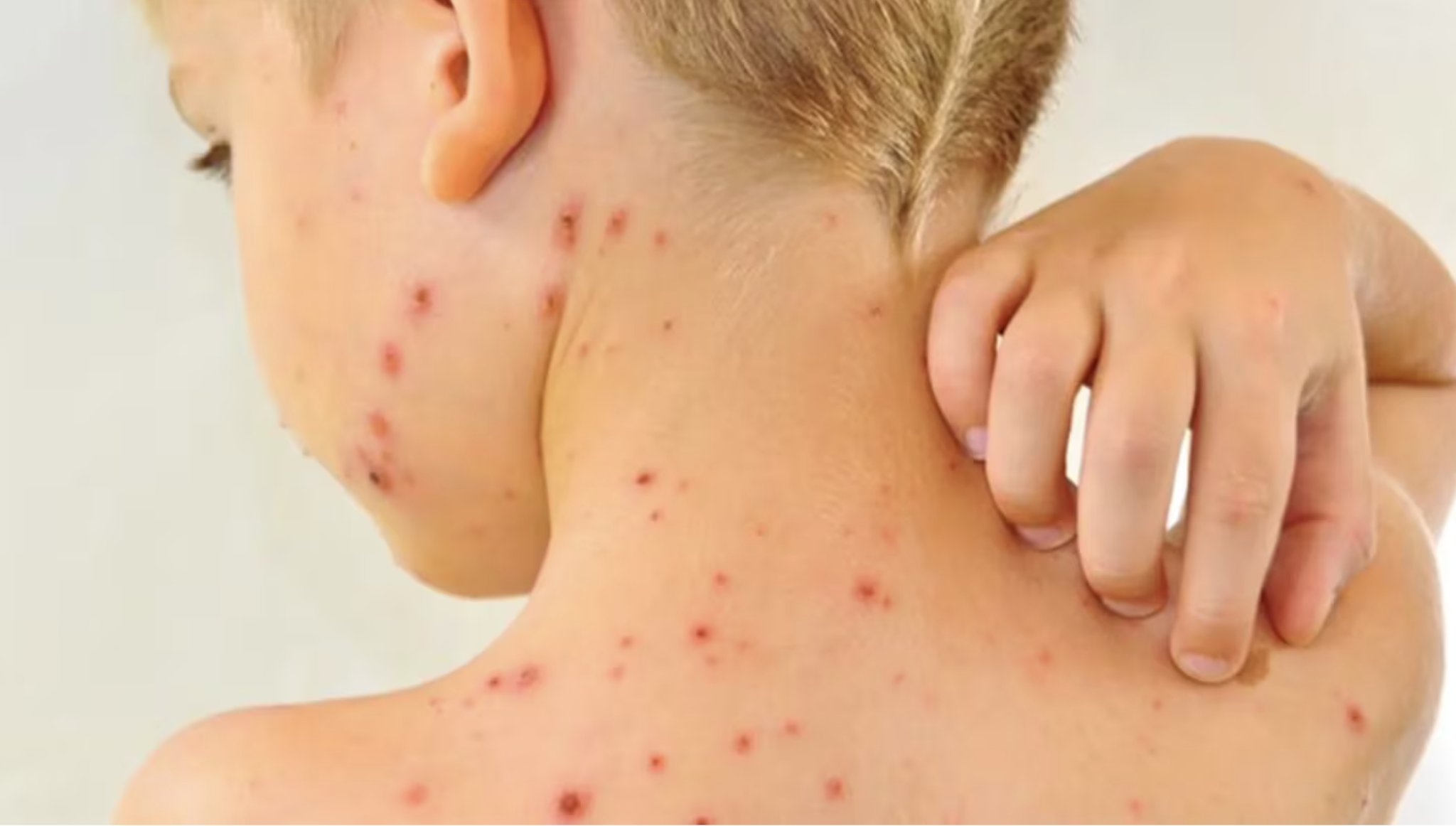 Alerta en EEUU: temen que más de 100 niños hayan estado expuestos al virus más contagioso del mundo