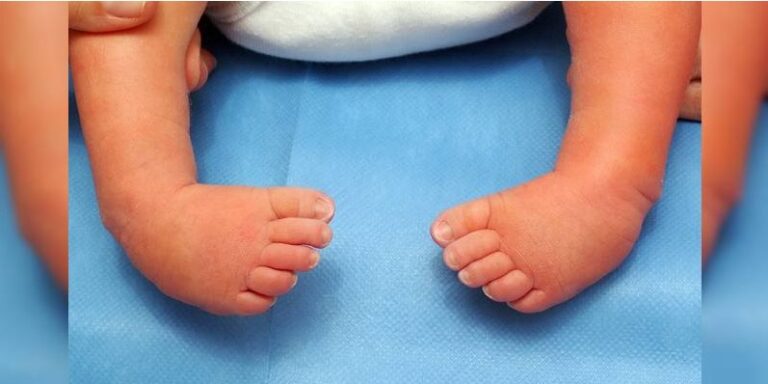 Minsa capacita a personal de occidente en malformaciones congénitas en los pies de los bebes