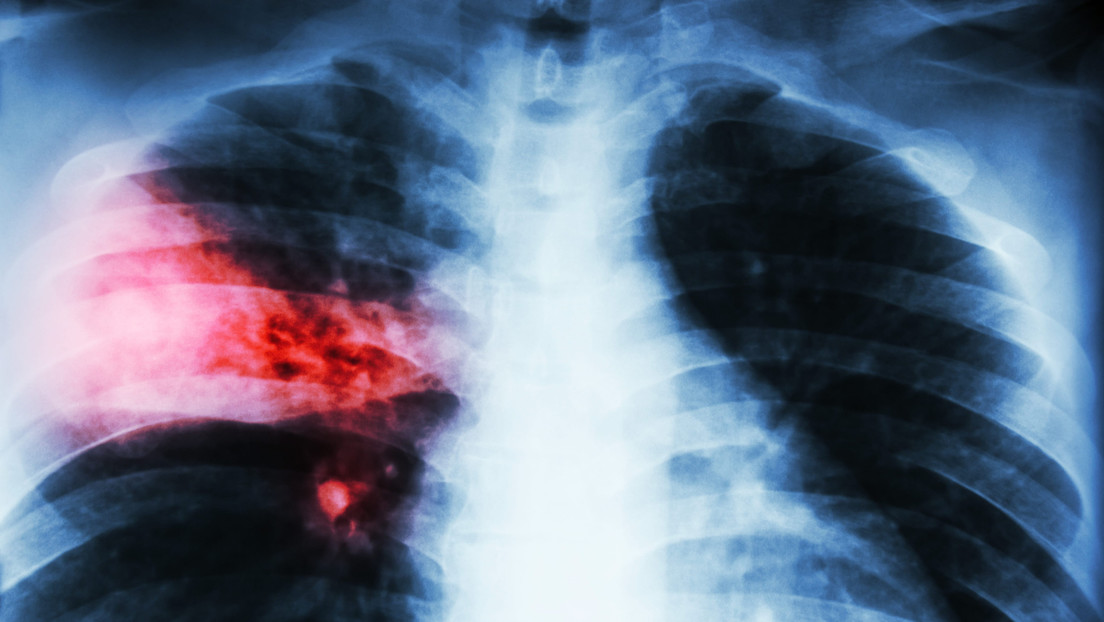 La clave contra el cáncer de pulmón podría estar en un inesperado ‘interruptor metabólico’