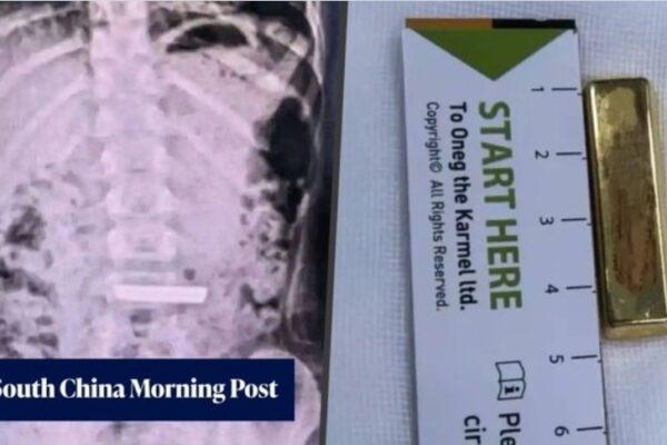 Un insólito hallazgo en el estómago de una niña que moviliza a un hospital chino