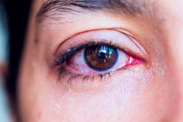 Joven acude al médico porque algo se movía dentro de un ojo y encuentran algo vivo allí