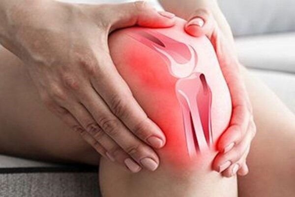 La radioterapia en dosis bajas podría ayudar a reducir la artritis de rodilla